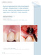 Apical approach to the treatment of peri-implantitis in the sthetic.pdf.jpg